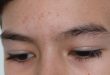 skincare untuk fungal acne