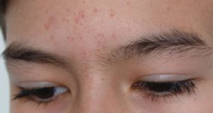 skincare untuk fungal acne