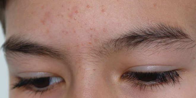 skincare untuk fungal acne